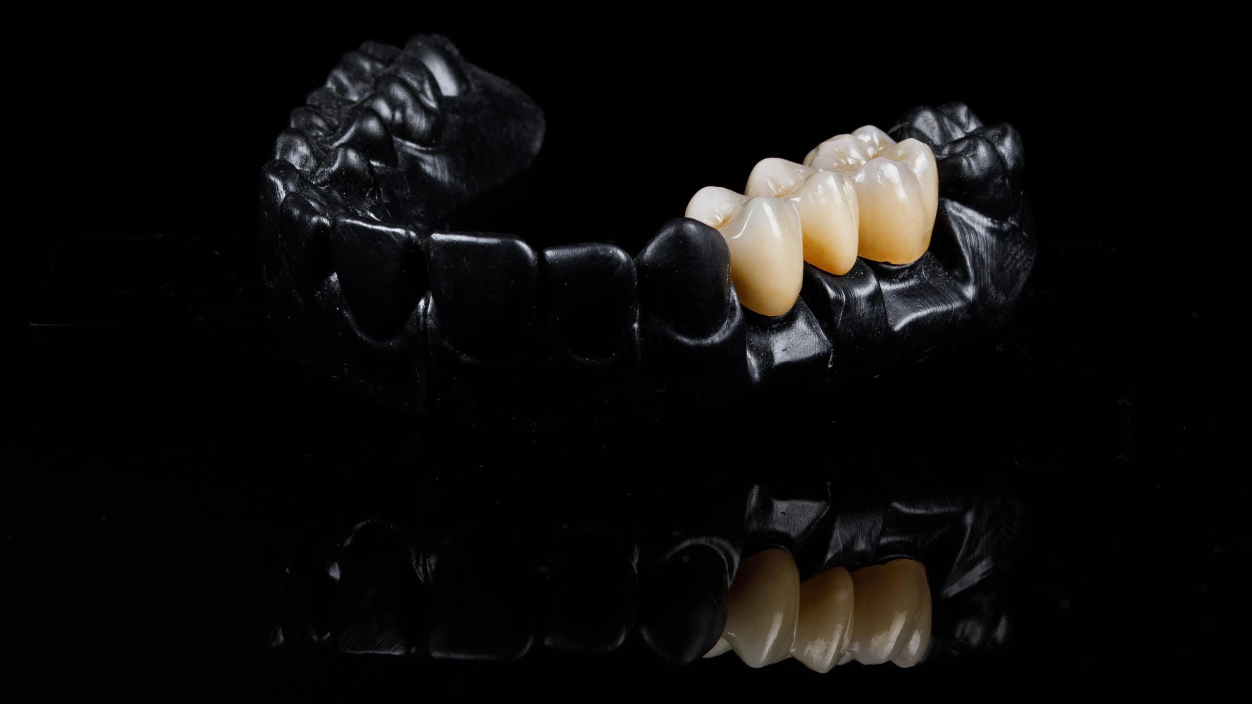 black dental model of the jaw with a bridge prosthesis and zircon on a black background